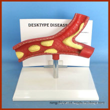 Desktype Disease Artery Anatomical Model Pathological